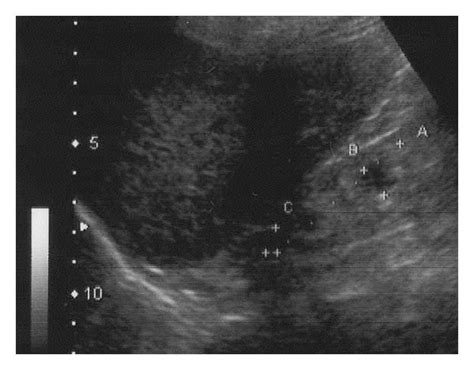 Example Of Sonographic Measurements Of The Same Patient First