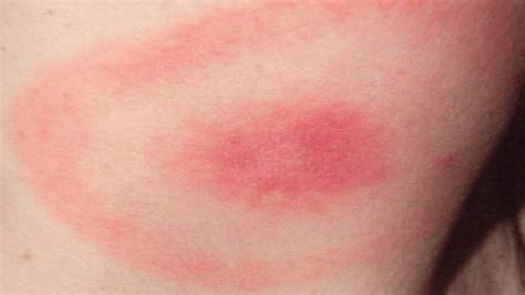 Nur wenn man sich sehr unsicher ist, ob man die zecke komplett entfernen konnte und nicht noch der kopf in der stichstelle hängt, sollte man sich nicht scheuen, seinen arzt um hilfe zu bitten. Borreliose-Gefahr kein Grund für Hysterie - tirol.ORF.at
