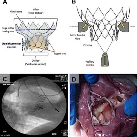 Highlife Transcatheter Mitral Valve Replacement System The