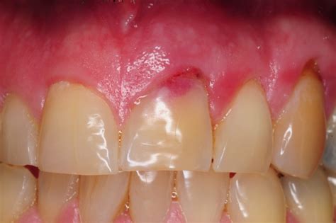 Internal Resorption External Resorption Of Tooth Pink Tooth Kazemi Oral