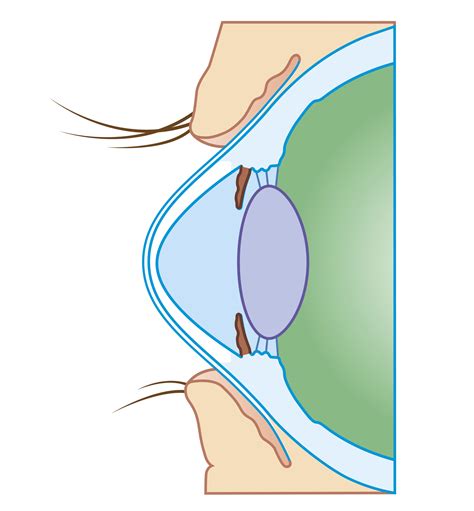 Corneal Cross Linking Eyes And Cxl
