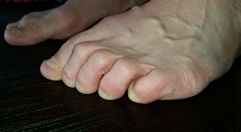 Toe Deformities Foot Surgery London