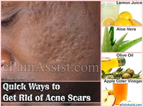 Quick Ways To Get Rid Of Acne Scars