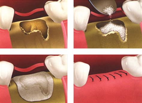 Bone Grafting Morgan And Lemke Periodontics And Dental Implants