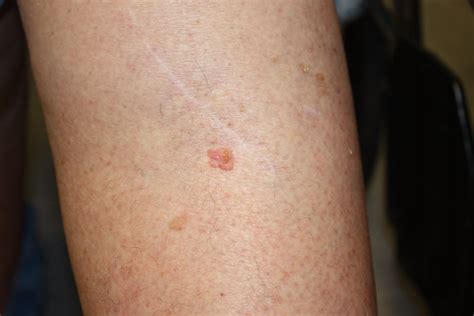 Can You Get Skin Cancer On Your Leg Cancerwalls