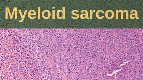 What Is Myeloid Sarcoma Pathology Mini Tutorials Youtube