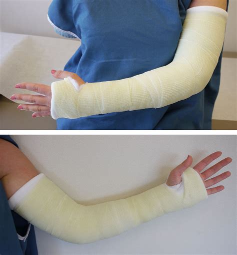 Care Of Casts And Splints Orthoinfo Aaos