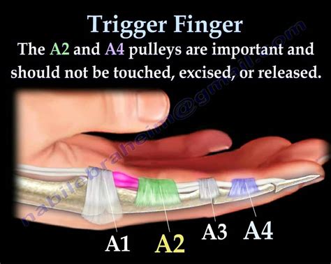 Trigger Finger And Thumb Everything You Need To Know Dr Nabil