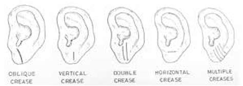 Figure 1 From Diagonal Ear Lobe Crease As A Marker Of Coronary Artery