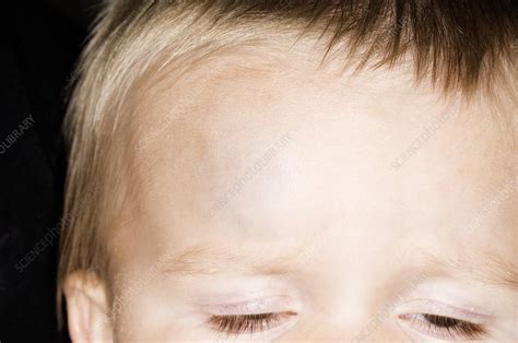 Bump on the forehead in a child - Stock Image - C009/0127 - Science