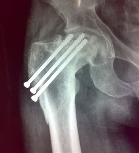 Femoral Neck Fractures Presentation And Treatment Bone And Spine