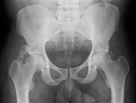 Lesser trochanter (trochanter minor) is a medial prominence located just inferior to neck. The Pelvis and Hip