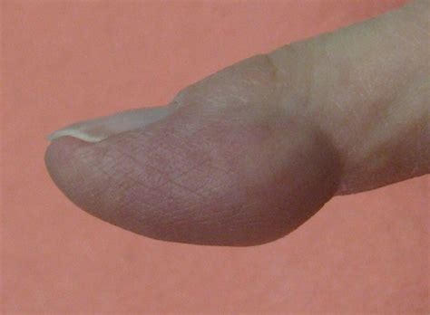 Derm Dx Growth On The Left Index Finger Dermatology Advisor