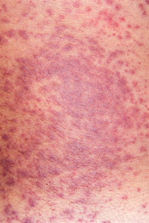 Rash Caused By Allergy To Trimethoprim Photograph By Dr P Marazzi