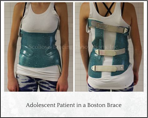 Comparing Scoliosis Braces Scoliosis Bracing Innovations