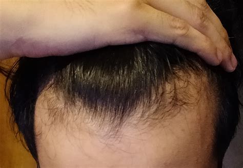Check spelling or type a new query. How To Know If Your Hair Is Thinning Reddit