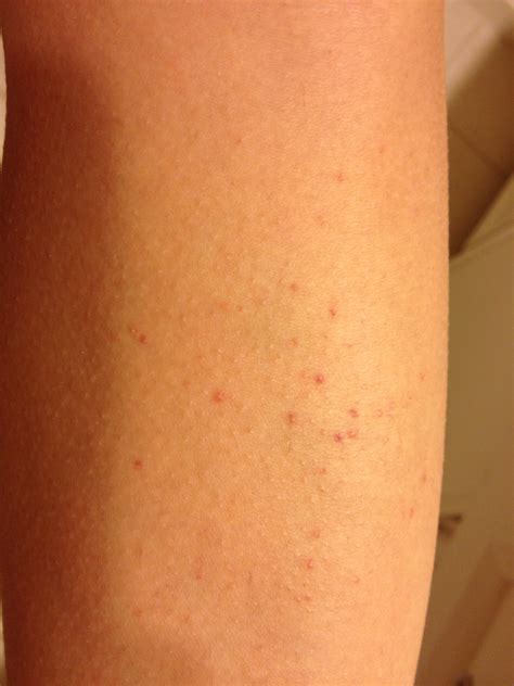 Small Red Dots On Leg Pictures Photos