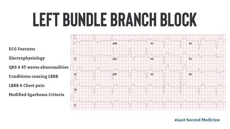 Left Bundle Branch Block ECG Features Electrophysiology Causes