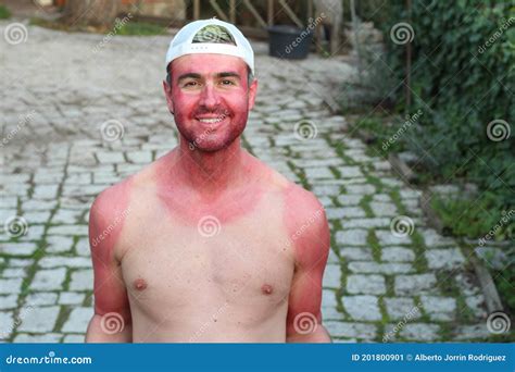 Man With Pale Complexion Getting Sunburnt Stock Image Image Of Fool