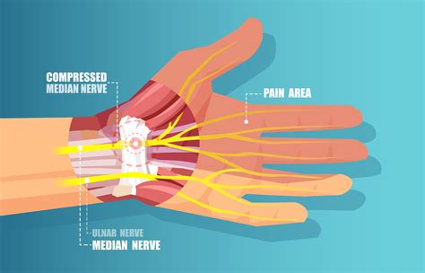 What Is Carpal Tunnel Syndrome — Orthopedics Hawaii
