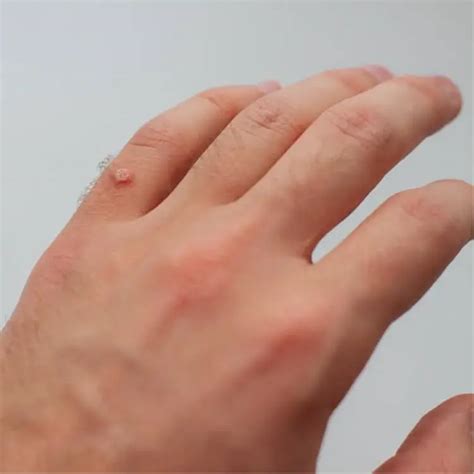 Warts Overview Causes Types Treatment And Prevention