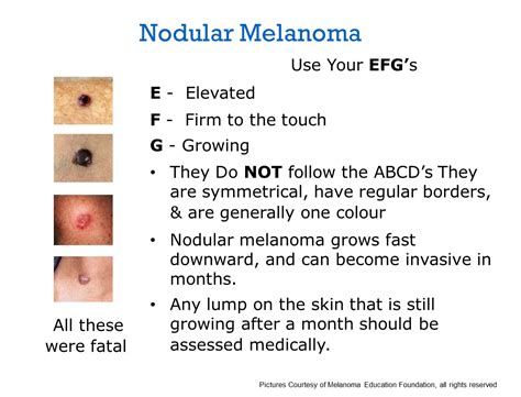 In the early stages of skin cancer, it can look like what would appear as a brand new mole or freckle or it can develop within an existing mole that you have had for years and years. Mission "Melanoma": Melanoma - BEYOND the ABCD's