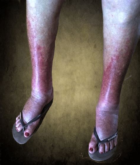 Cutaneous Purpuric Rash And Edema Of The Ankles And Feet Case Courtesy Download Scientific
