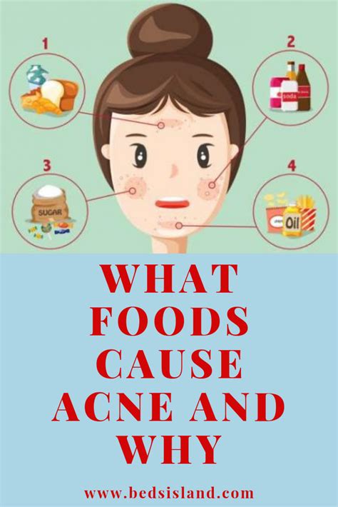 What Foods Cause Acne And Why Acne Causing Foods Acne Diet Acne