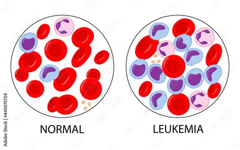 Comparison Of Normal Blood And Leukemia Blood Cancer Red And White