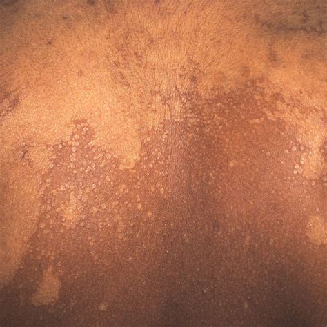Tinea Versicolar Numerous Hypopigmented Scaly Maculespatches On The