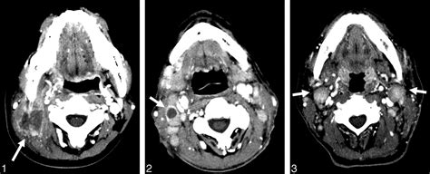 Peripheral T Cell Lymphoma In The Neck Ct Findings Of Lymph Node