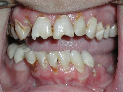 Badly Decayed Teeth Extreme Pictures Dr Caputo Palm Harbor Dentist