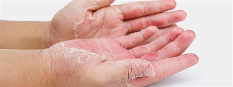 Hand Washing And Hand Dermatitis Eczema Association Of New Zealand Inc