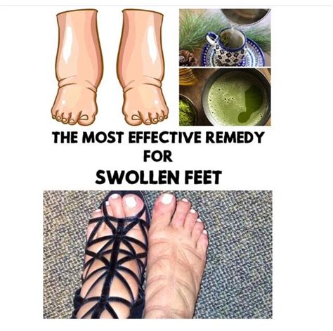 The Most Effective Remedy For Swollen Feet Foot Remedies Swollen