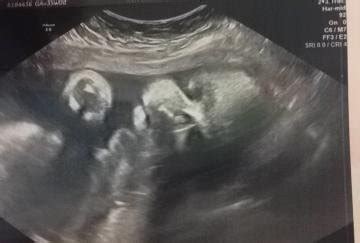 Maybe you would like to learn more about one of these? Did anyone get a good view of baby's face with 2D ultrasound(not 3D/4D) - BabyCenter