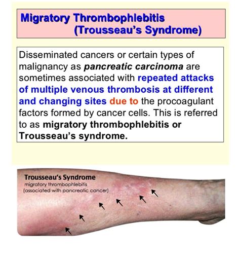 Migratory Thrombophlebitis Trousseau Syndrome 【 Also Trosier