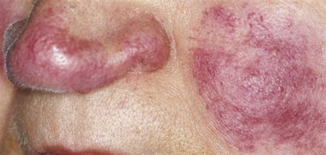 Il pericardio è una membrana che avvolge il cuore, ha una funzione protettiva la pericardite si cura soprattutto con farmaci che riducono l'infiammazione e il dolore, un farmaco a. Lupus Eritematoso Sistemico, i sintomi subdoli di una ...