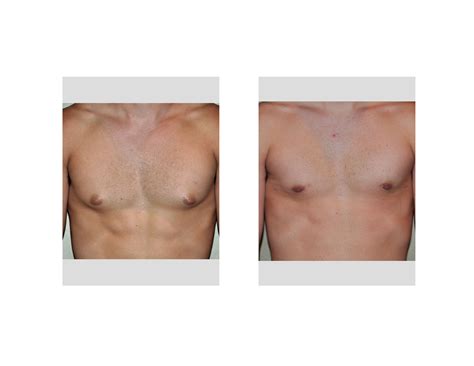 Case Study Correction Of Supplement Induced Gynecomastia In Athletes