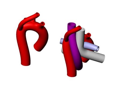 Aberrant Right Subclavian Artery Anomaly 3D Print Model Heart