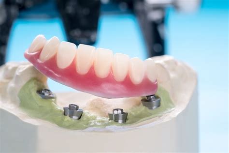 Implant Supported Dentures Procedure Faqs Bright Smile Dental Chicago