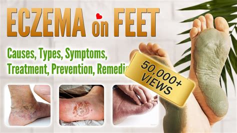 Eczema On Foot Causes Symptoms Types Treatment Prevention And Home