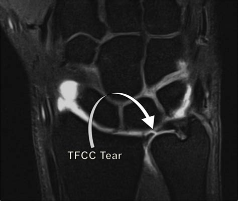 Triangular Fibrocartilage Complex Injury Tfcc Motus Physical Therapy