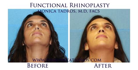 Getting nose job covered by insurance. Average Cost of Rhinoplasty in New Jersey
