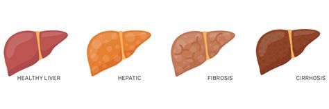 Hepatitis is inflammation of the liver tissue. Your liver and hepatitis | Positively Aware