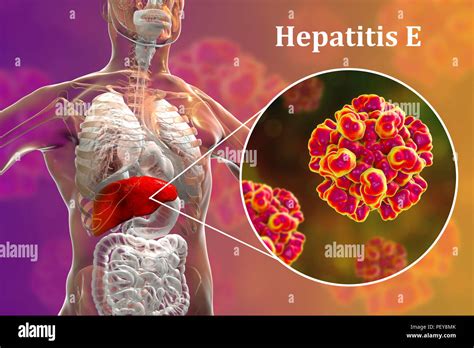 Hepatitis E Infection Computer Illustration Showing The Liver And A