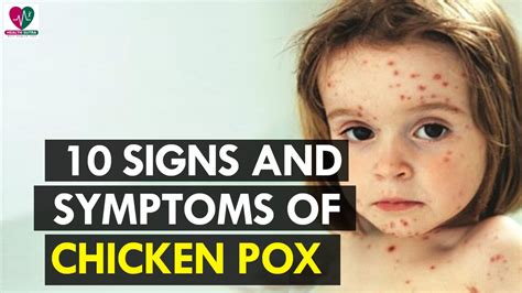 10 Signs And Symptoms Of Chicken Pox Health Sutra Youtube