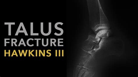 Hawkins III Talus Fracture YouTube