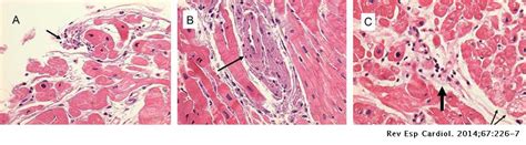 El músculo cardíaco puede dañarse aún más si el sistema inmunitario envía anticuerpos para tratar de combatir la causa. Imagen histológica y angiocardiográfica de miocarditis ...