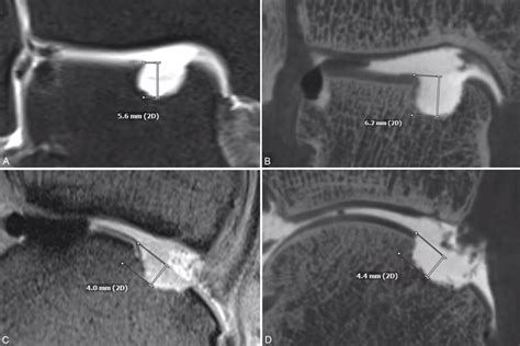 Different Mr Sequences And Flat Panel Ct Arthrography Measurements