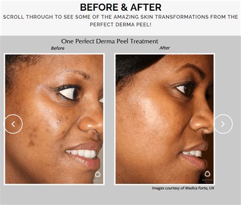 The Perfect Derma Peel Dermatology Care Of Charlotte Dermatology Care